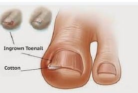 Ingrown Toe nail pledget