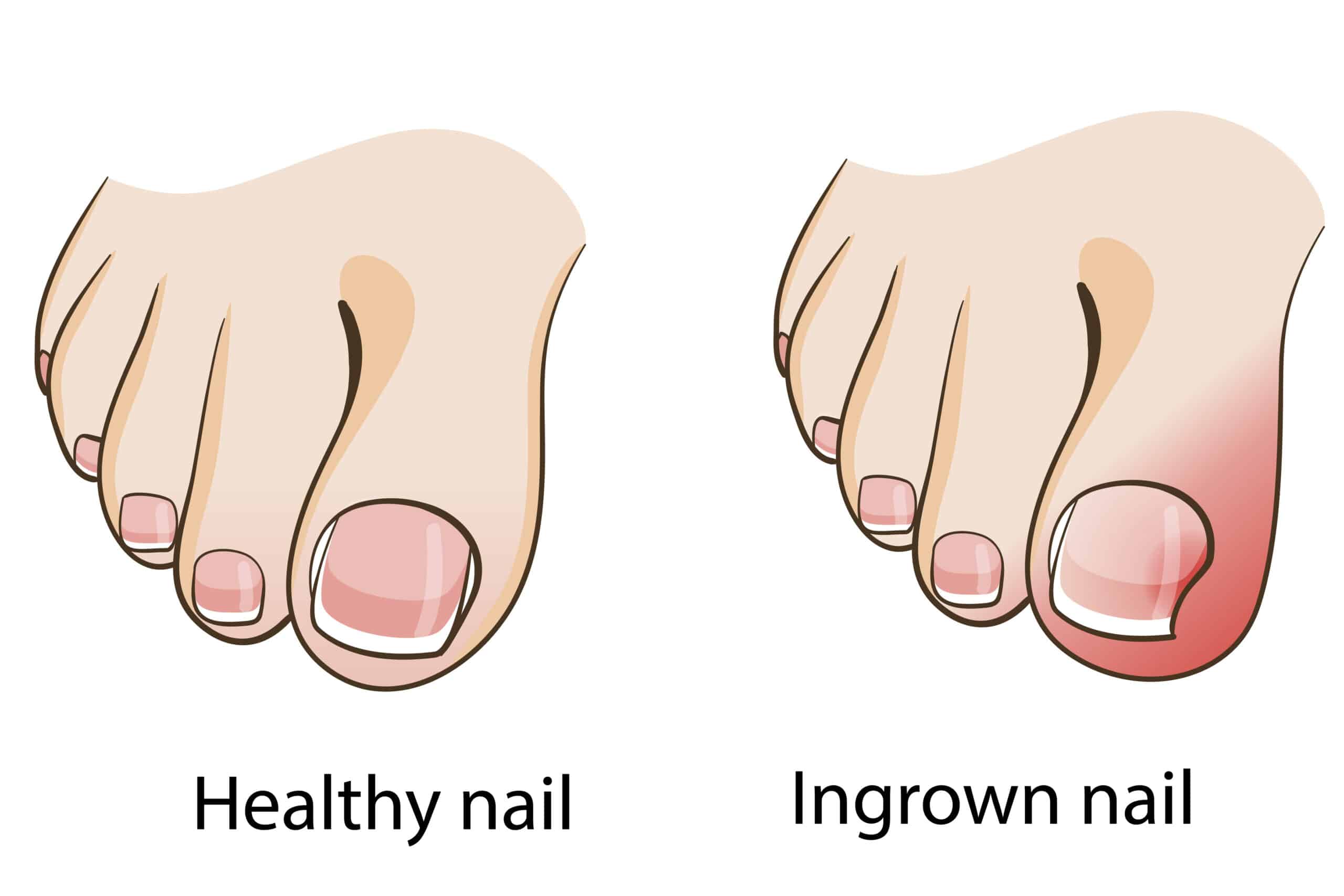 healthy and ingrown toe nail